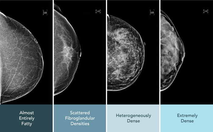 Breast density diagram